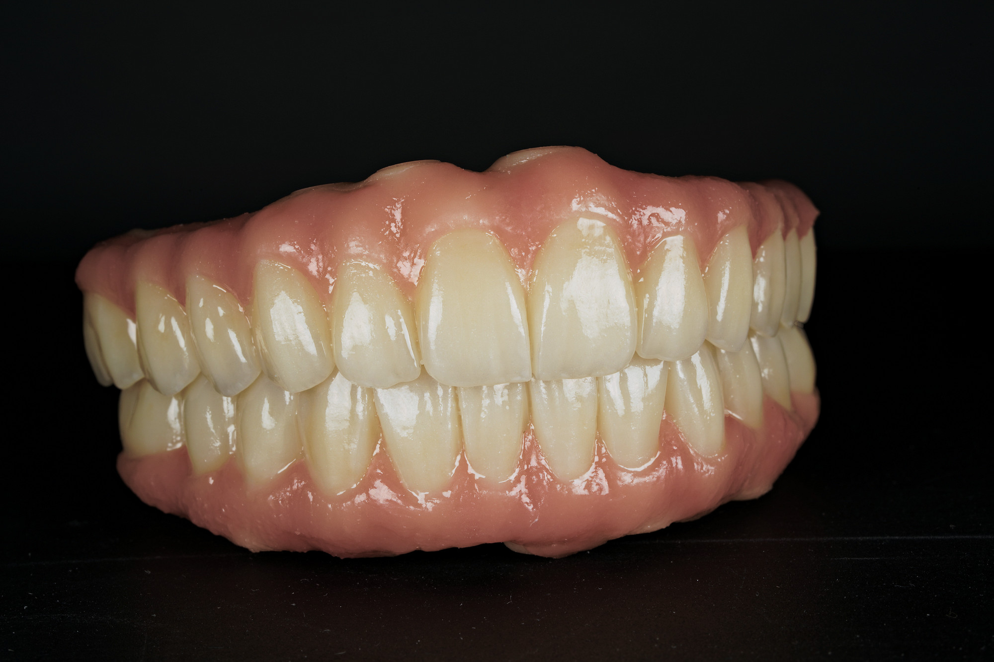 Riabilitazione completa superiore e inferiore in zirconia integrale, vista di tre quarti